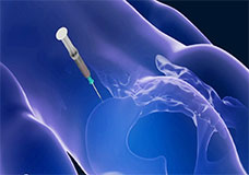 Bone Marrow Aspirate Concentrate (BMAC) Treatment