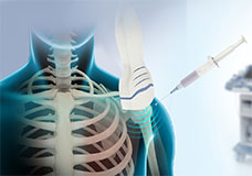 Ultrasound-Guided Injections